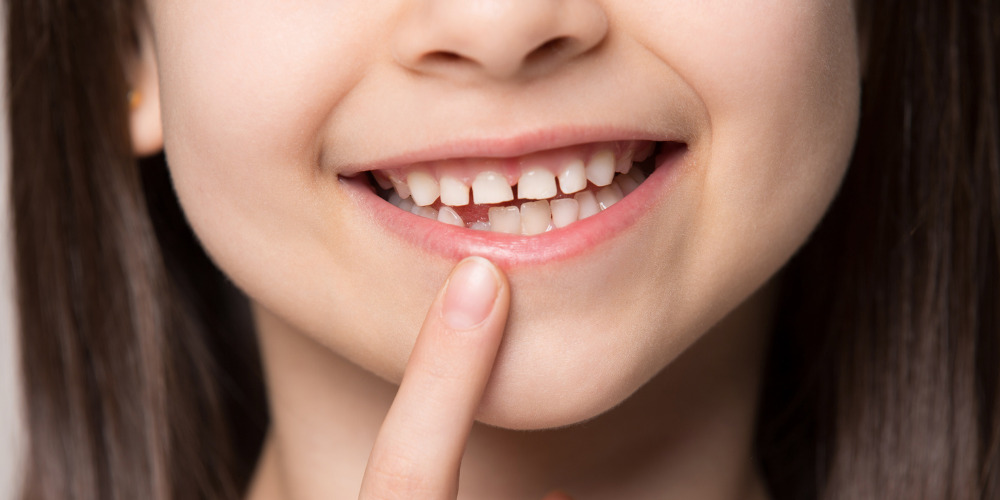 大人乳歯や永久歯が生えない方、先天性欠如歯をご存知ですか？